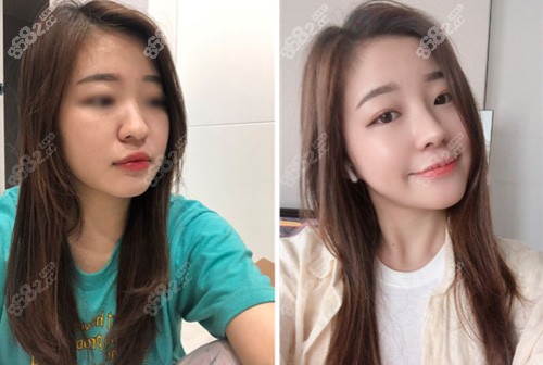 韩国整鼻子得花多少钱?这几个关键点你需要知道!