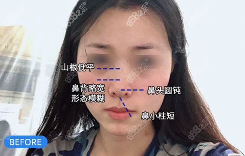 上海仁爱肋软骨隆鼻术前照片 上海仁爱肋软骨隆鼻术前照片