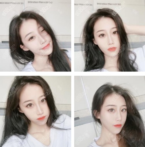 天津伊颂整形极塑生态美鼻案例术后60天 天津伊颂整形极塑生态美鼻案例术后60天