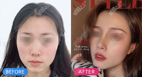 上海仁爱肋软骨隆鼻对比照 上海仁爱肋软骨隆鼻对比照