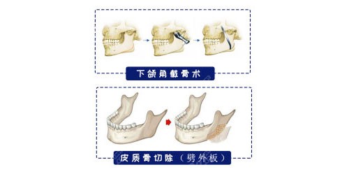 上海仁爱轮廓两件套(下颌角+去外板) 上海仁爱轮廓两件套(下颌角+去外板)