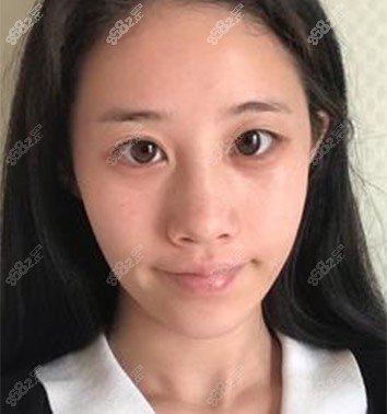 天津伊颂整形极塑生态美鼻案例术前 天津伊颂整形极塑生态美鼻案例术前