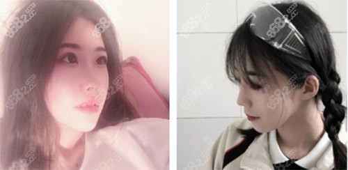 天津伊颂整形极塑生态美鼻案例术后15天 天津伊颂整形极塑生态美鼻案例术后15天
