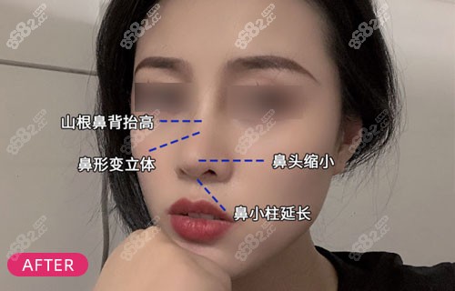 上海仁爱肋软骨隆鼻术后照片 上海仁爱肋软骨隆鼻术后照片