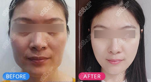 上海仁爱医院下颌角+去外板瘦脸整形案例 上海仁爱医院下颌角+去外板瘦脸整形案例