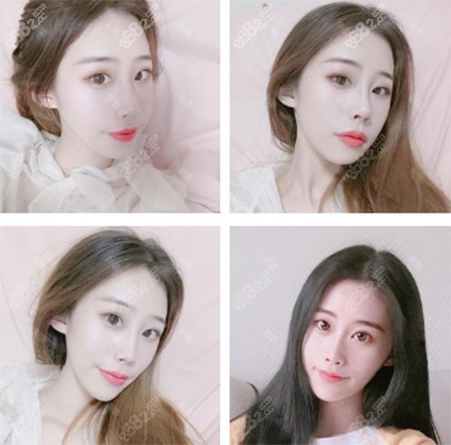 天津伊颂整形极塑生态美鼻案例术后35天 天津伊颂整形极塑生态美鼻案例术后35天