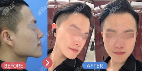 上海仁爱医院下颌角+去外板轮廓对比照片 上海仁爱医院下颌角+去外板轮廓对比照片