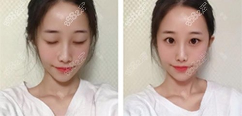 天津伊颂整形极塑生态美鼻案例术后7天 天津伊颂整形极塑生态美鼻案例术后7天