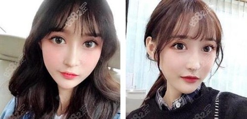 在三亚红妆尚医学美容做芭比眼部多项术后45天 在三亚红妆尚医学美容做芭比眼部多项术后45天