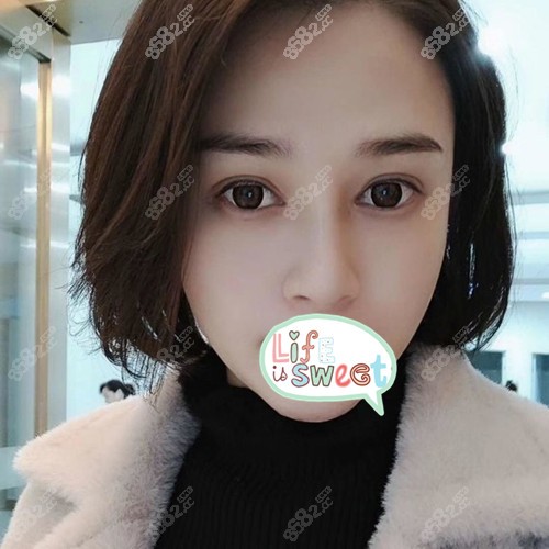 桂林星范叶向东假体隆鼻一个月效果图 桂林星范叶向东假体隆鼻一个月效果图