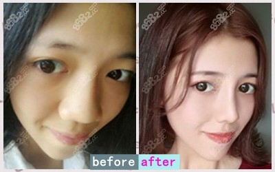 沈阳蓝天医疗美容黄瑞兴芭比鼻整形案例 沈阳蓝天医疗美容黄瑞兴芭比鼻整形案例