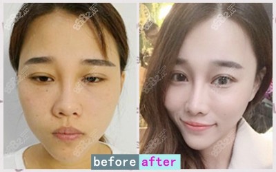 沈阳蓝天医疗美容医院黄瑞兴八度艺术美鼻案例 沈阳蓝天医疗美容医院黄瑞兴八度艺术美鼻案例
