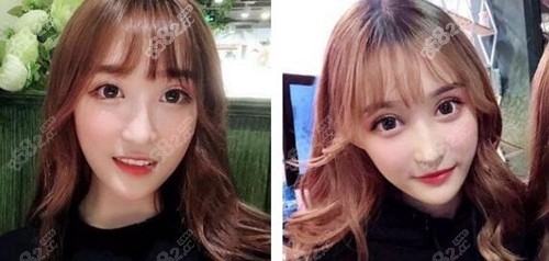 在三亚红妆尚医学美容做芭比眼部多项术后1个月 在三亚红妆尚医学美容做芭比眼部多项术后1个月