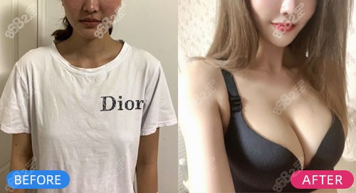 上海仁爱曼托假体丰胸对比照片 上海仁爱曼托假体丰胸对比照片