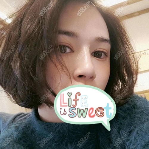 威宁艳冠假体隆鼻术后7天 威宁艳冠假体隆鼻术后7天
