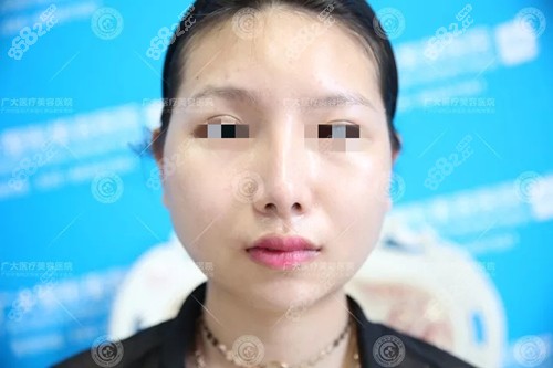 术前下颌角手术之前.jpg 术前下颌角手术之前.jpg