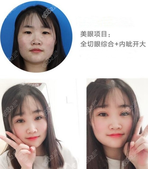 江西萍乡星悦医疗美容陶军桃花明眸眼综合案例