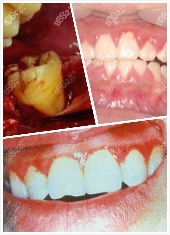 牙龈炎早期和晚期图片及症状图片是什么样子呢?