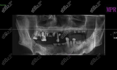 三门峡口腔种植前拍牙片