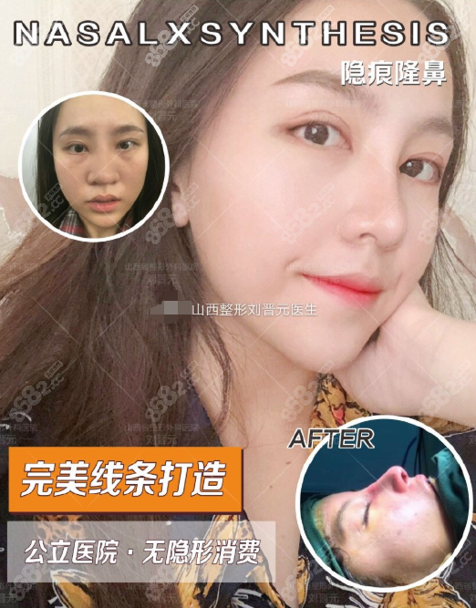 刘晋元医生超体隆鼻前后对比案例