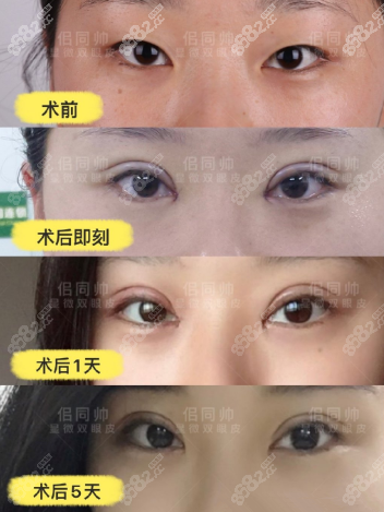 上海华美佀同帅6毫米开扇形双眼皮3个月恢复图,含眼修复,眼部对比照