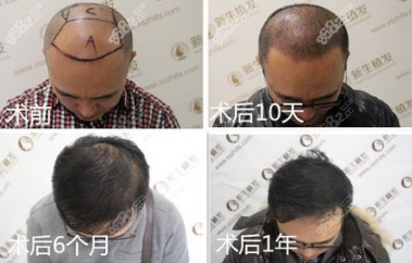 新生植发前额 头顶种植效果图