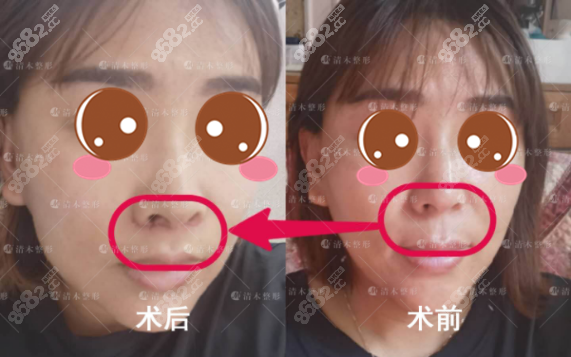 国内做人中缩短术好的医生,北京清木沈薇凭案例价格上榜