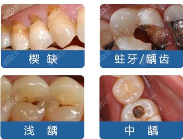 需要进行补牙的牙齿问题