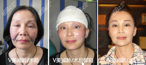 青春除皱 电波拉皮 正文 加减美医院不用多说了,就是以面部抗衰老手术