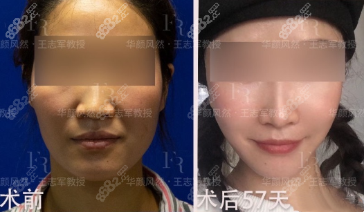西安王志军医生面部小拉皮手术30天对比图,除皱真的明显