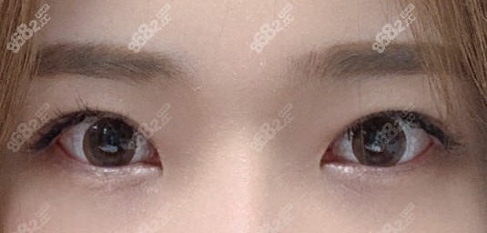 韩国TS整形外科眼修复术后一年效果