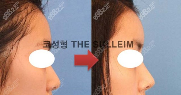 韩国林柱焕医生做鼻综合效果对比图