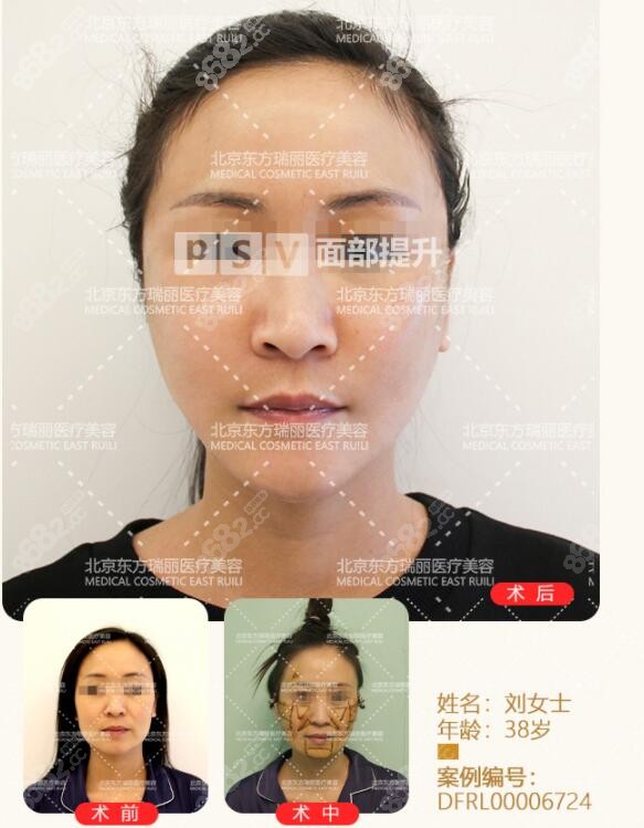 北京做小切口拉皮手术好的医生排名榜,这五位医生荣耀