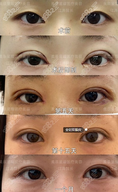 江涛医生做双眼皮怎么样?成都美辰星耀用效果图揭晓真相