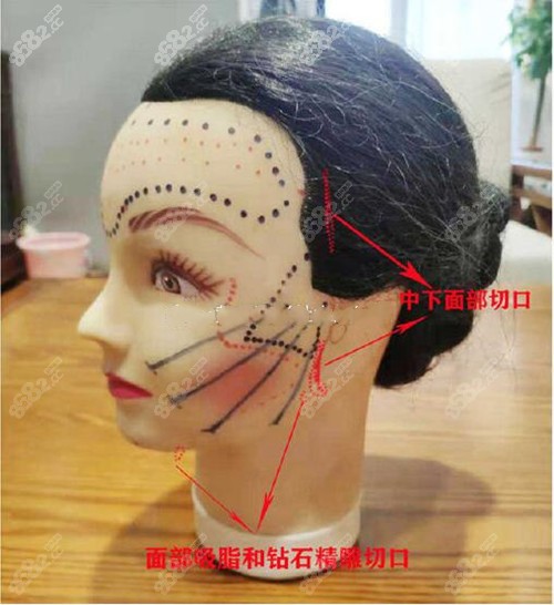 面部小拉皮切口