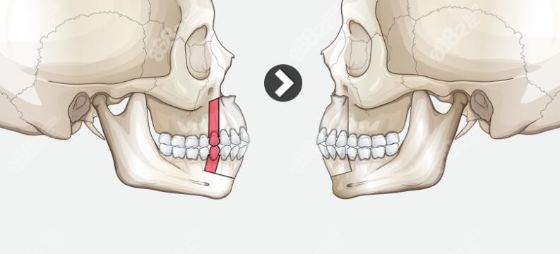如果是骨性凸嘴,同时伴有牙齿前突问题,可能会需要拔掉牙齿,收费会贵2
