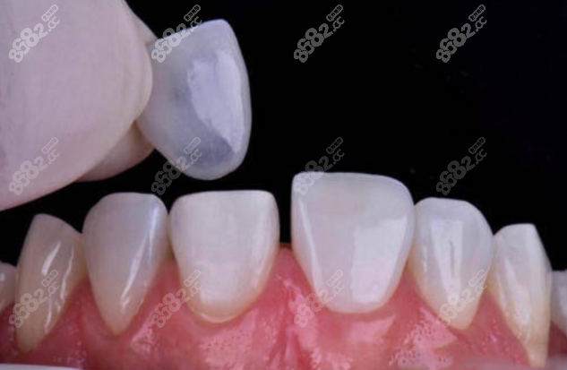 怎么修复可以防止牙缝越来越大!