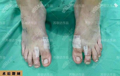 大脚骨能矫正过来吗?分析马桂文与苏敬达做大脚骨手术技术