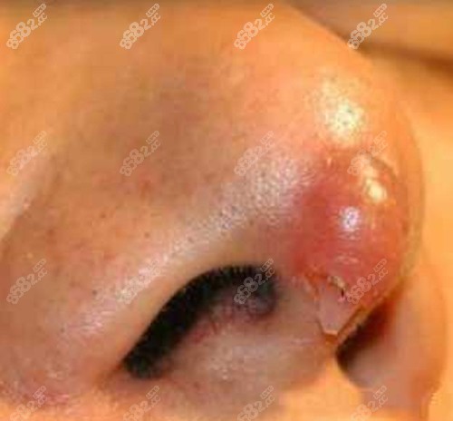 假体外露示意图图