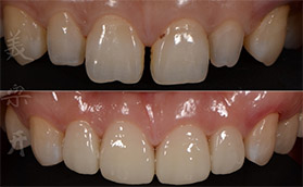 长沙美奥口腔牙齿美白贴面治疗前后对比案例