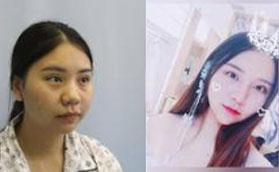 在洛阳孔繁荣医疗美容门诊部进行眼鼻综合后华丽变身