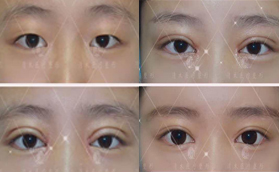 大同清木整形官网双眼皮手术前后对比案例