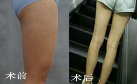 长沙美之峰医疗美容医院大腿吸脂案例对比照片