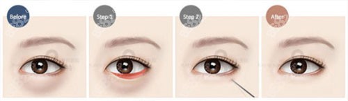 上海伊莱美祛眼袋手术方法