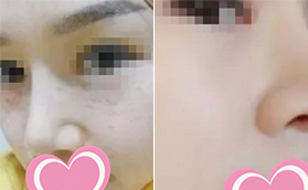 在海南兰颜慧医学美容医院做了皮肤治疗，案例对比明显！