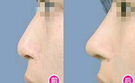 在海口鹏爱做了韩式注射玻尿酸隆鼻案例对比，效果明显！