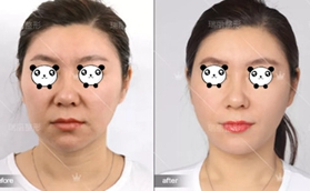 案例记录了我在哈尔滨瑞丽做面部埋线提升的效果