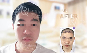 广州仁健医疗美容门诊部植发前后案例对比照