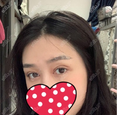 真人案例小姐姐找重庆好美李曾显做开扇形双眼皮7mm效果图