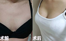 长沙亚韩美容整形医院假体隆胸手术案例